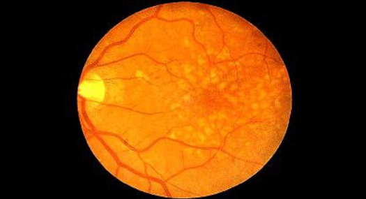 retina with dry macular degeneration, photo by Carolina Retina